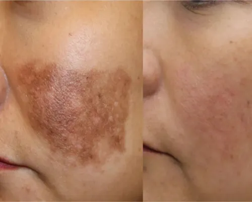 Women who got pigmentation therapy before and after, showing better skin tone & less discolouration